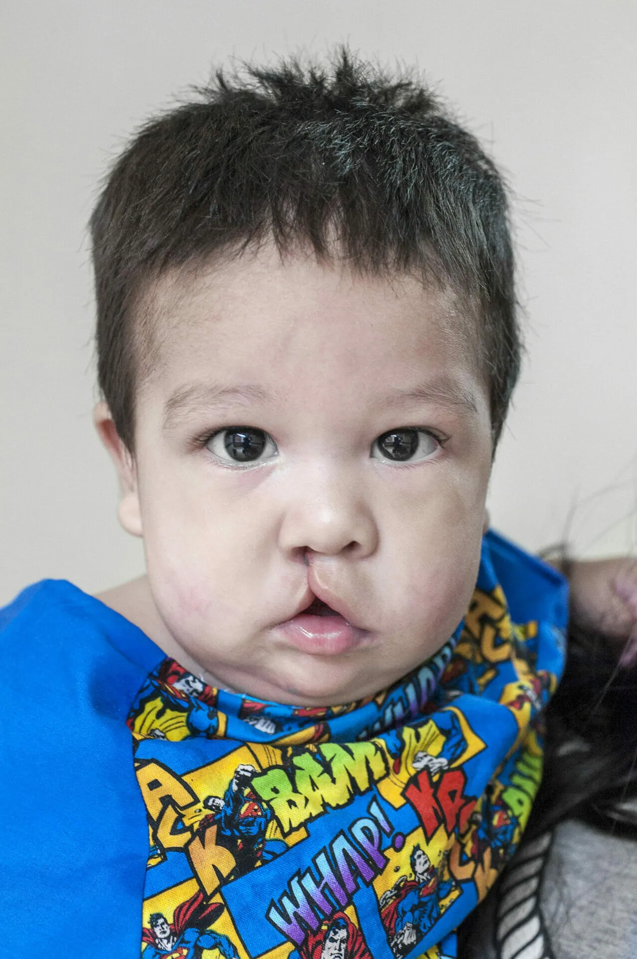 BOL_2018_Santa Cruz_007_ Jack Sandoval Cortez_Before_007, Jack Sandoval Cortez, Male, Cleft UCL, Child, 6 Months old, Before, Waiting for Surgery.