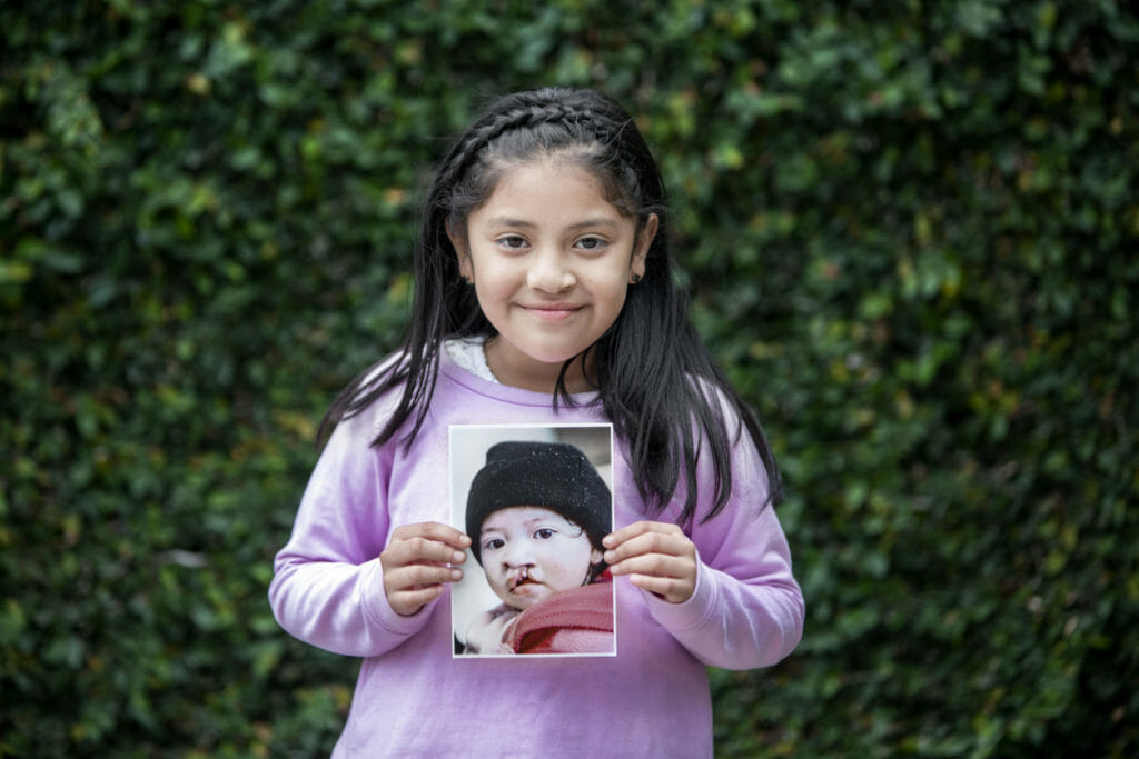 GTM_2019_Guatemala City_033_Alexandri Nicolle Rodriguez Juarez_After_
Alexandry Nicolle Rodriguez Juarez after, 8 years after surgery. Patient 033, Alexandri Nicolle Rodriguez Juarez, UCL, 11 months in 2011. Operation Smile's inaugural Mission to Guatemala, December 1-9, 2011 at Hospital Centro Medico Militar, in Guatemala City, Guatemala.on Operation Smile Mission to Guatemala City, Guatemala, May 18-24, 2019 at Hospital Juan Pablo II, in Guatemala City, Guatemala. (Operation Smile Photo by Carlos Rueda)